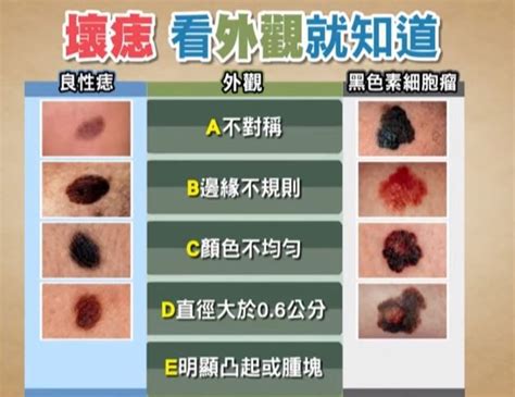 不規則黑痣|我的「痣」會是惡性腫瘤嗎？醫師告訴你：符合這5特。